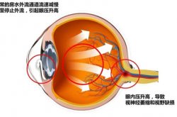 青光眼能治愈吗？听听专家怎么说