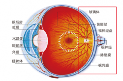 视物扭曲了？小心得了黄斑病变！