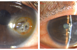 海外游子角膜穿孔，紧急回国在爱尔接受角膜移植