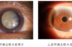 紧急提醒！这个时间段罹患白内障的患者不可再拖！