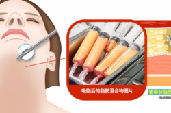 告别双下巴困扰：体验韩国麦恩医院引领的革命性吸脂技术