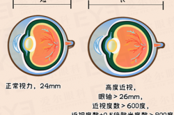 近视超过600度？这些运动建议你不要做！