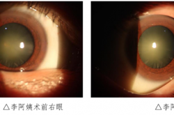 泰酷辣！3D可视化手术系统让她重见清晰视界