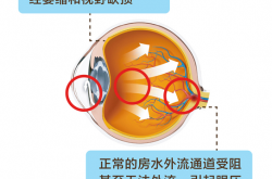 眼睛“太漂亮”，为什么要警惕是先天性青光眼？