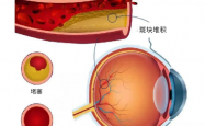 您听说过“眼中风”吗？