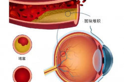 您听说过“眼中风”吗？