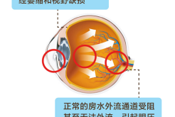 眼睛“太漂亮”，为什么要警惕是先天性青光眼？